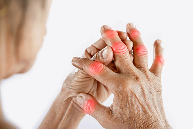 Morning Joint Stiffness? It Could Be Rheumatoid Arthritis
